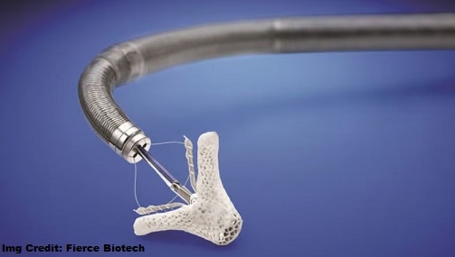 FDA Approves Abbott''s Triclip Device, a Breakthrough in Treating Leaky Tricuspid Heart Valves